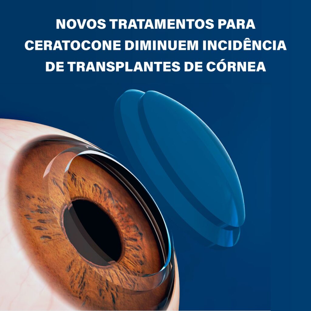 Tratamento para ceratocone apresenta avanços Tratamento para ceratocone apresenta avanços