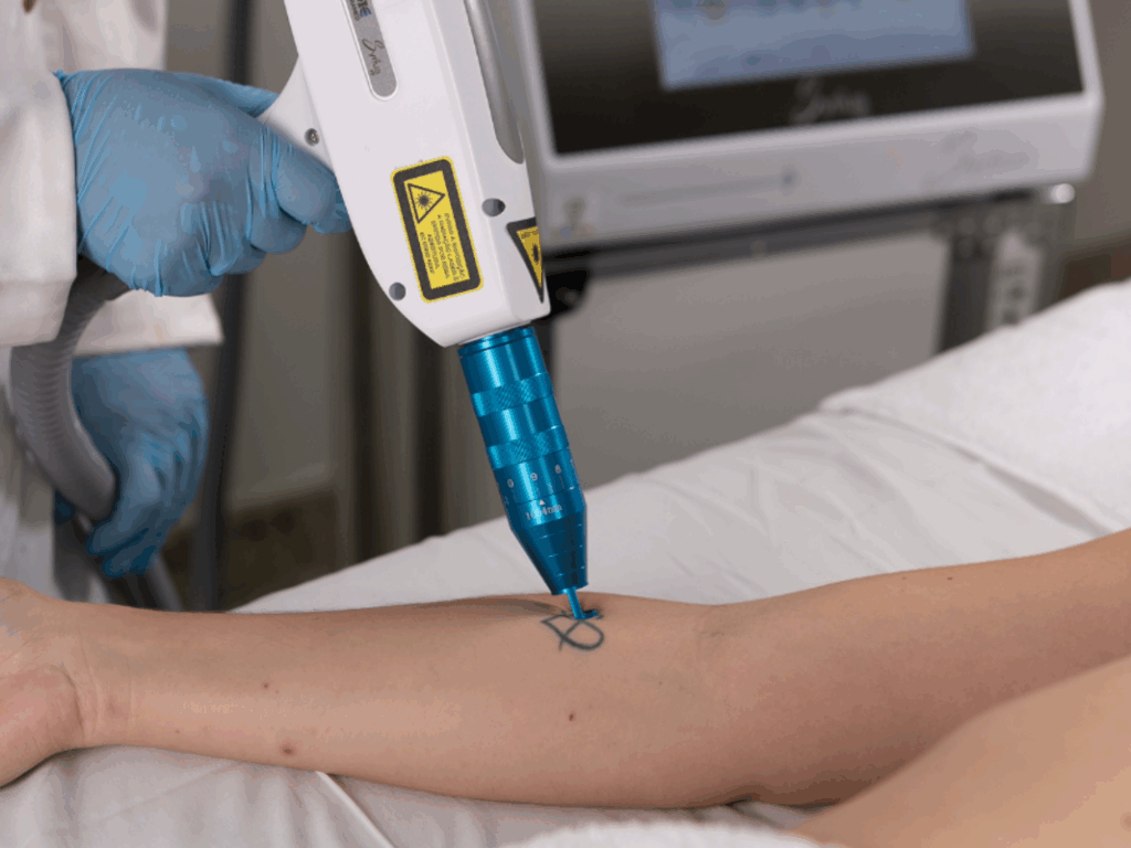 Procura por remoção de tatuagens cresce no Brasil