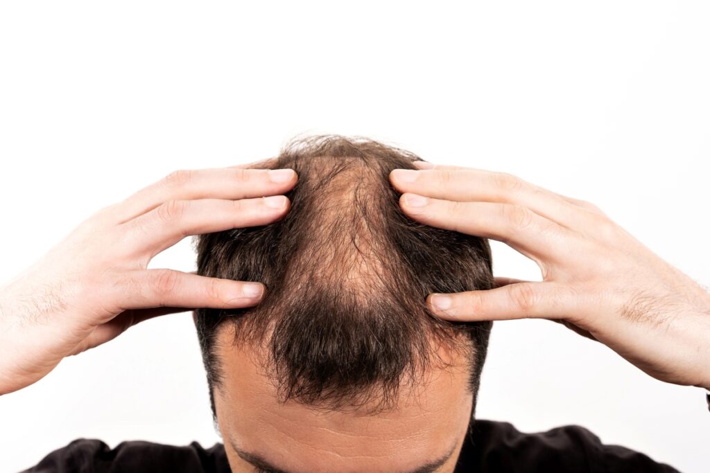 Alopecia: técnicas de tricologia podem oferecer soluções
