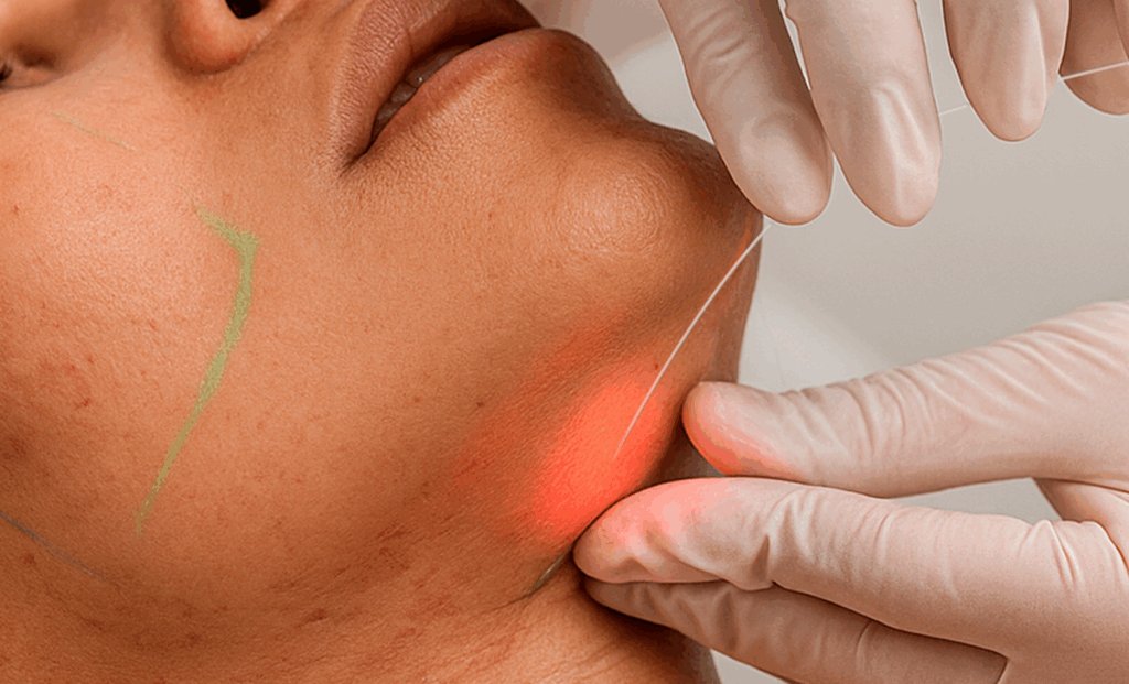 Laser subdérmico surge como alternativa à lipoaspiração