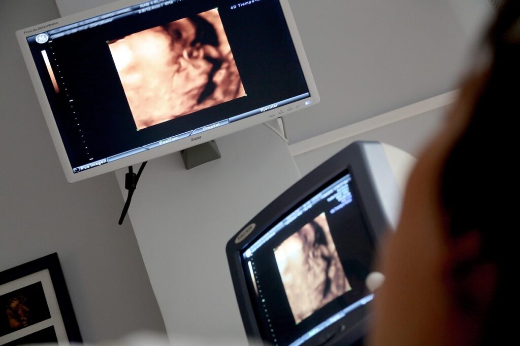 Pesquisa reforça técnica fetal para hérnia diafragmática Pesquisa reforça técnica fetal para hérnia diafragmática