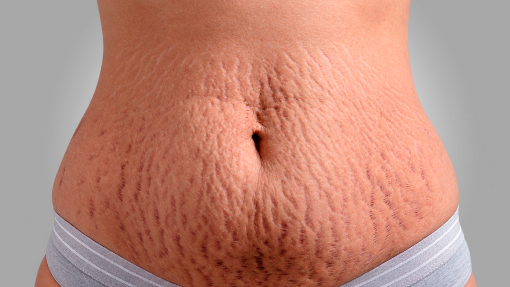 Cirurgia plástica e estética se aliam contra as estrias