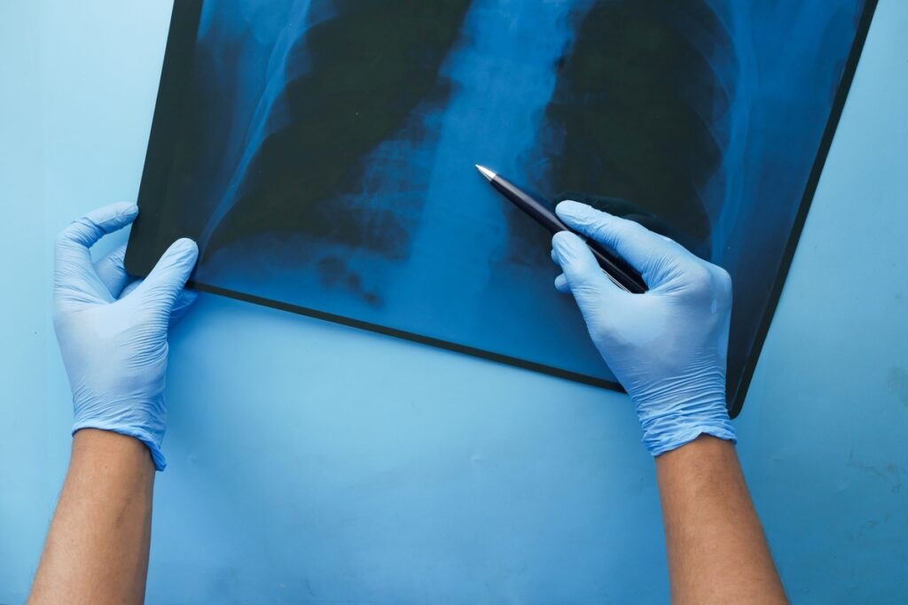 CONITEC abre consulta para Hipertensão Arterial Pulmonar CONITEC abre consulta para Hipertensão Arterial Pulmonar
