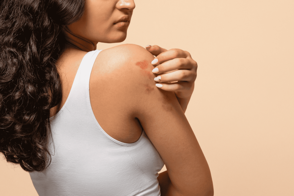 Mês da Dermatite Atópica: os impactos da doença na pele Mês da Dermatite Atópica: os impactos da doença na pele