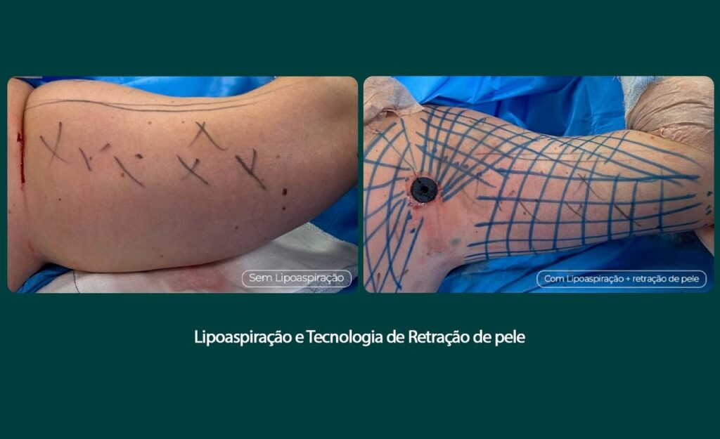Tratamento remove flacidez do braço com tecnologia associada Tratamento remove flacidez do braço com tecnologia associada